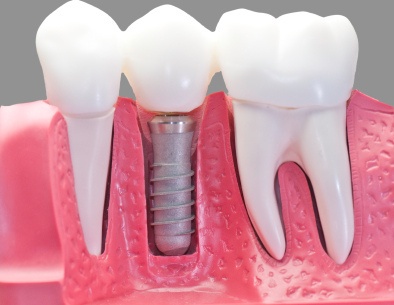 implantes