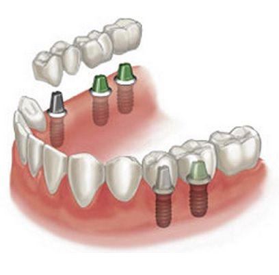 implantes