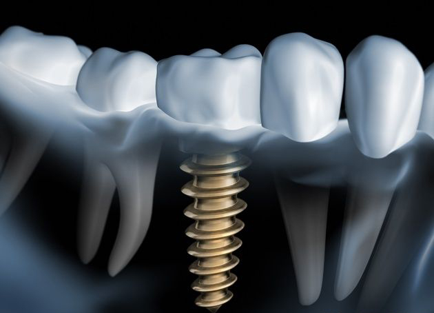 implantes
