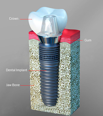 implantes